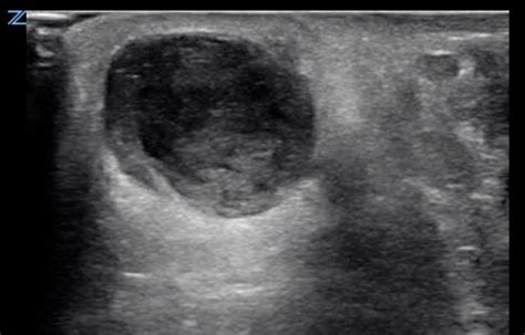 Sonoguide // Abscess Evaluation