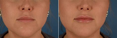 Injectable Fillers photos - Aesthetic Surgery Center