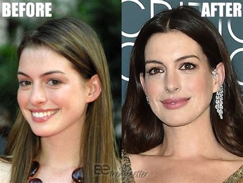 Anne Hathaway's Plastic Surgery Before and After