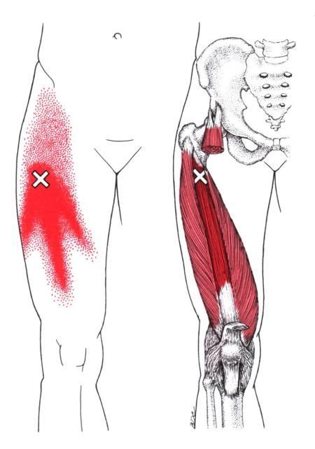 Vastus Intermedius | The Trigger Point & Referred Pain Guide | Trigger points, Referred pain ...