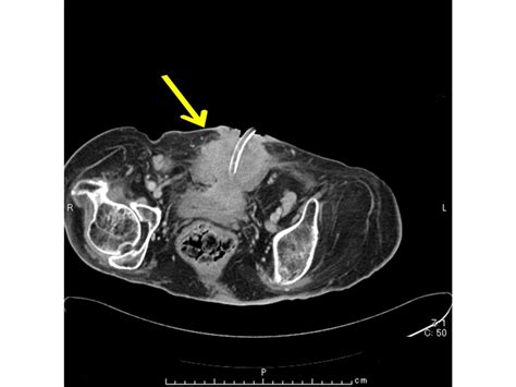 A case of squamous cell carcinoma arising from a suprapubic cystostomy tract | BMC Urology ...