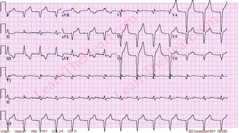 AIVR ECG | LearntheHeart.com