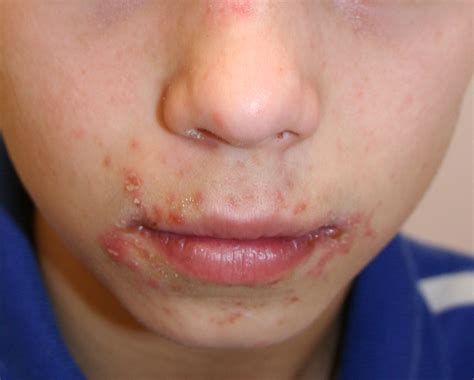 Impetigo - Bing images