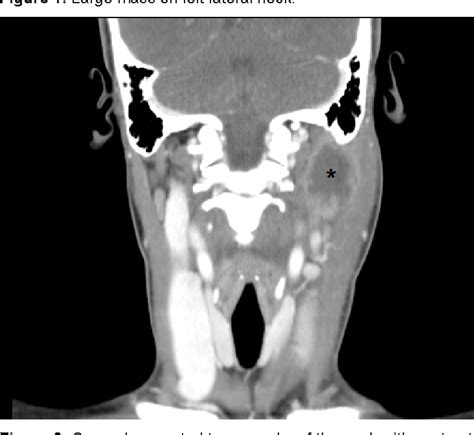 Figure 2 from Lemierre’s Syndrome | Semantic Scholar