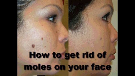 Getting Rid Of Moles 5 Important Facts