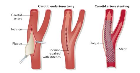 Complications of Carotid Endarterectomy in the Postanesthesia Care Unit