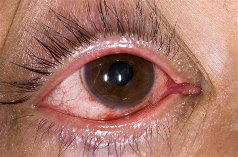 Adenoviral conjunctivitis of the eye - Stock Image - C007/2735 - Science Photo Library