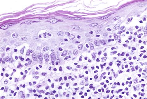 Cutaneous T-Cell Lymphoma Incidence on the Rise in the United States- Cancer Therapy Advisor