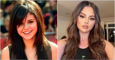 Selena Gomez Plastic Surgery - Milano Klinik