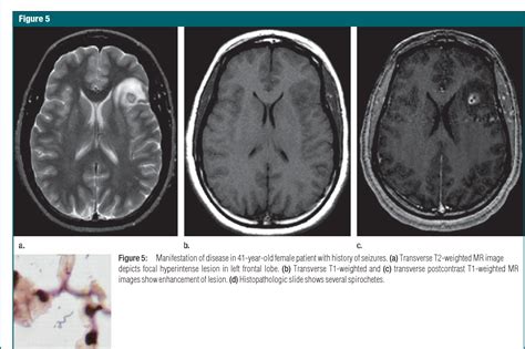 Lyme Disease And Brain Lesions - Pregnancy Depression