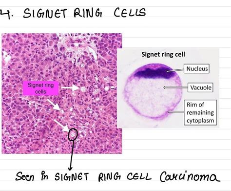 Signet Ring Cells - MEDizzy