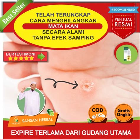 Obat Herbal Mata Ikan Dan Kapalan, Obat Alami Mata Ikan Di Wajah, Obat ...