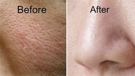 Large Pores Treatment in Dubai - Laser Skin Care Clinic Dubai