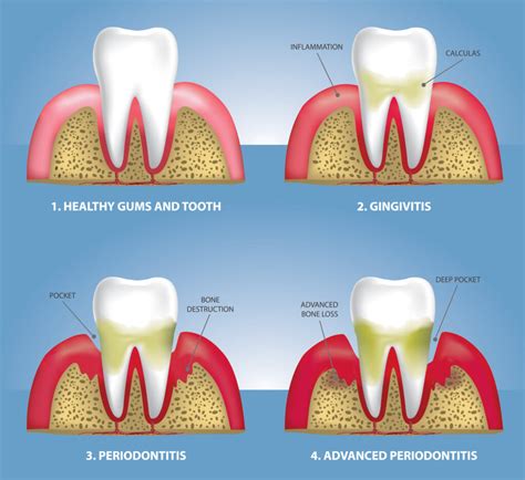 Gum Disease Diagram