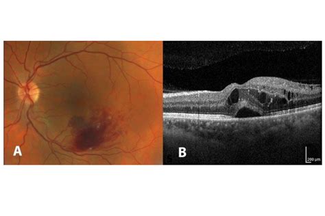 Macular oedema: new light on the horizon?