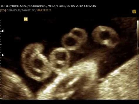 Single umbilical artery ultrasound - YouTube