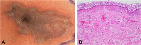 Xylazine-induced acute skin necrosis in two patients who inject fentanyl - JAAD Case Reports