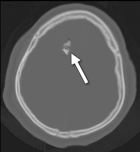 Traumatic Brain Injury: Imaging Patterns and Complications | RadioGraphics