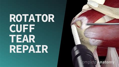 How To Repair A Rotator Cuff Tear - Tomorrowfall9