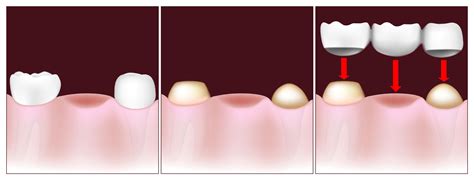 Dental Bridge Procedure