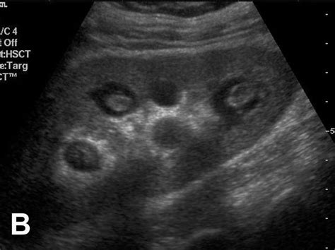 renal papillary necrosis ultrasound - Google Search | Radiologie, Échographie