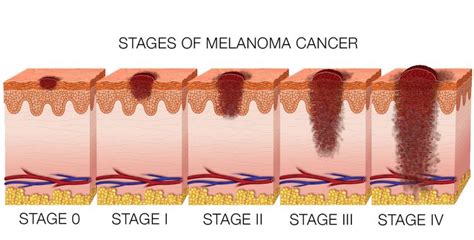 Skin Cancer Melanoma- The Four Stages