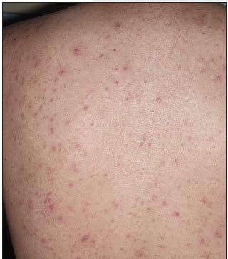 Pityrosporum Folliculitis | Consultant360