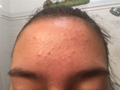 [skin concerns] have had really bad forehead acne for three months and can’t find any products ...