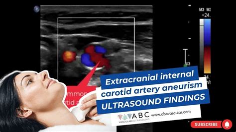 EXTRACRANIAL INTERNAL CAROTID ARTERY ANEURYSM: ULTRASOUND FINDINGS - YouTube