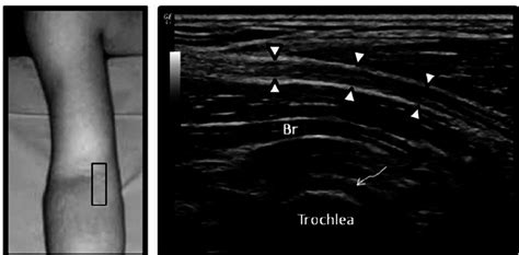 A diagram is provided of the antecubital fossa and the associated... | Download Scientific Diagram