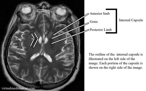 Internal capsule = pricey brain real estate Internal Capsule, Basal Ganglia, Cerebral Cortex ...