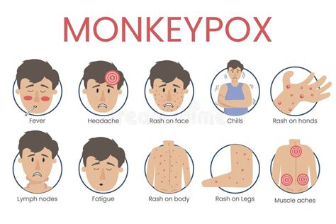 Monkey Pox Virus Concept Showing the Symptoms of the Disease: Fever, Headache, Stock Vector ...