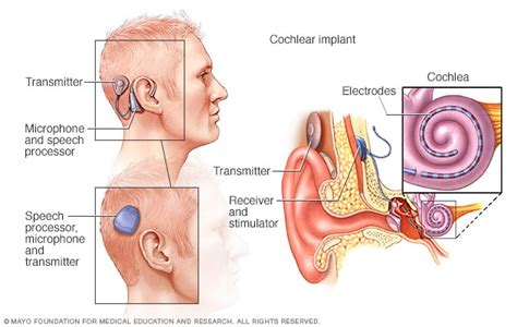 How cochlear implants work - Mayo Clinic