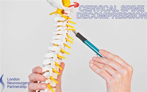 Cervical spine decompression - London Neurosurgery Partnership