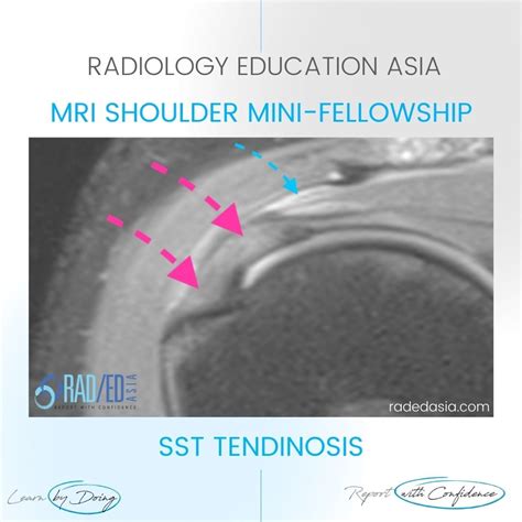 ROTATOR CUFF SUPRASPINATUS TENDINOSIS TENDINITIS MRI: WHAT'S WRONG WITH THE SST? - Radedasia