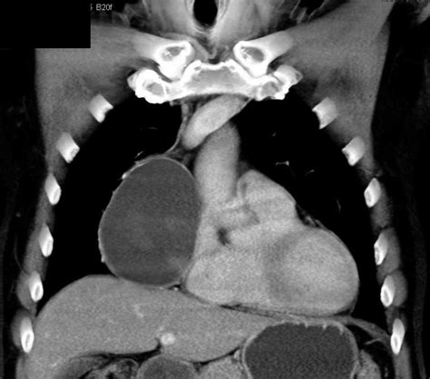 Fluid-Fluid Level in a Pericardial Cyst - Chest Case Studies - CTisus ...