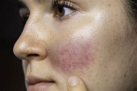 Rosacea: Understanding the 4 Types & Treatment