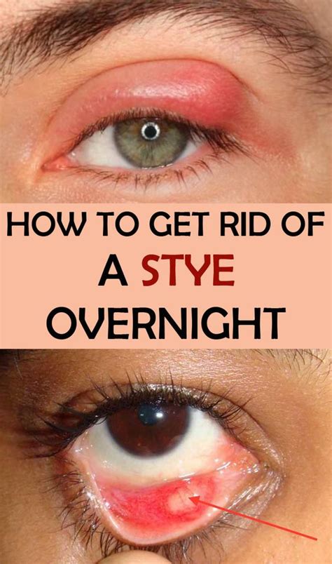 How To Get Rid Of a Stye Overnight | Wellness Click