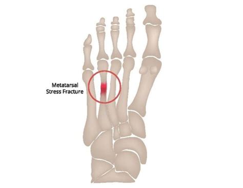 Metatarsal Bone Fracture