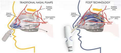 Trudhesa DHE Nasal Spray: Top 7 Reasons to Consider DHE for Migraine ...