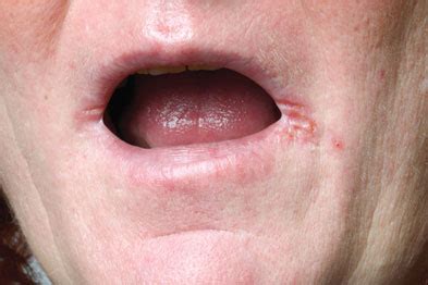 Pictorial case study: Painful sores | GPonline