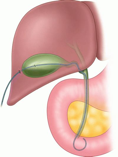 Percutaneous Cholecystostomy | Anesthesia Key