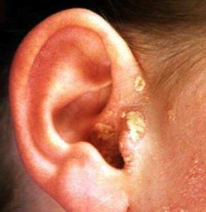 Dry Skin in Ears - Pictures, What Causes it and How to Treat