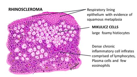 RHINOSCLEROMA - Pathology Made Simple