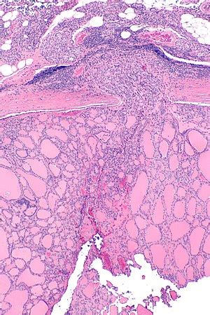 Follicular thyroid carcinoma - Libre Pathology