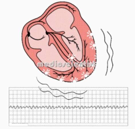 Supraventricular tachycardia and Ventricular fibrillation Causes ...