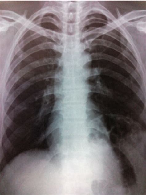 Chest X ray. Case 2 | Download Scientific Diagram