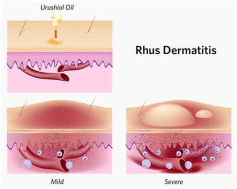 How Poison Ivy Causes a Rash | Tec Labs