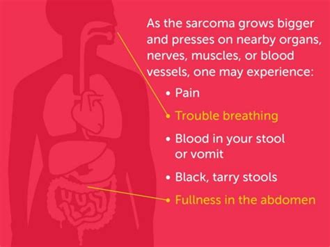 Soft Tissue Sarcomas: Symptoms and Risk Factors