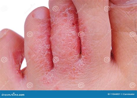 Athlete's Foot Fungus Stock Image - Image: 11044831